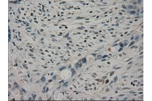 Immunohistochemical staining of paraffin-embedded Adenocarcinoma of colon tissue using anti-CRYABmouse monoclonal antibody. (CRYAB 抗体)