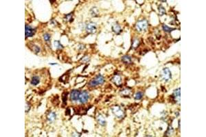 IHC analysis of FFPE human hepatocarcinoma stained with the Dnmt3a antibody (DNMT3A 抗体  (AA 457-486))