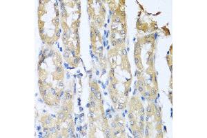 Immunohistochemistry of paraffin-embedded human gastric cancer using CCL3 antibody at dilution of 1:100 (40x lens). (CCL3 抗体)