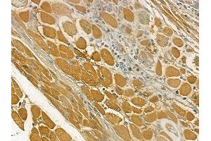 ABIN6260411 and ABIN6269331 at 1/100 staining human tongue carcinoma by IHC-P.