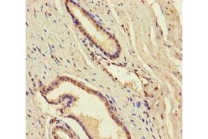 Immunohistochemistry of paraffin-embedded human prostate cancer using ABIN7144980 at dilution of 1:100 (DDX19A 抗体  (AA 1-478))