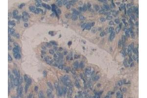 Detection of H2AFY in Human Colorectal cancer Tissue using Polyclonal Antibody to H2A Histone Family, Member Y (H2AFY)