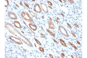 Formalin-fixed, paraffin-embedded human Renal Cell Carcinoma stained with Occludin Mouse Monoclonal Antibody (OCLN/2181). (Occludin 抗体  (AA 282-415))