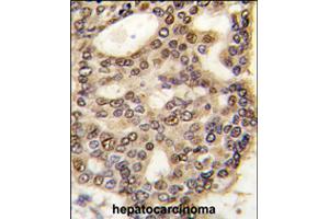 Formalin-fixed and paraffin-embedded human hepatocellular carcinoma reacted with HDGF polyclonal antibody  , which was peroxidase-conjugated to the secondary antibody, followed by DAB staining .