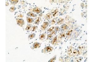 Phospho-MAFB (Ser304) Antibody at 1/100 staining Human gastric cancer and adjacent normal tissues by IHC-P. (MAFB 抗体  (pSer304))