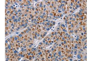 The image on the left is immunohistochemistry of paraffin-embedded Human liver cancer tissue using ABIN7190333(COX18 Antibody) at dilution 1/20, on the right is treated with synthetic peptide. (COX18 抗体)