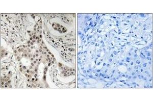 Immunohistochemistry analysis of paraffin-embedded human breast carcinoma, using NCoA2 (Phospho-Ser736) Antibody. (NCOA2 抗体  (pSer736))