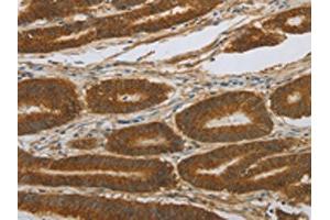 The image on the left is immunohistochemistry of paraffin-embedded Human colon cancer tissue using ABIN7191676(NOTCH4 Antibody) at dilution 1/30, on the right is treated with synthetic peptide. (NOTCH4 抗体)