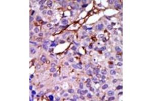 Formalin-fixed and paraffin-embedded human cancer tissue (breast carcinoma) reacted with the primary antibody, which was peroxidase-conjugated to the secondary antibody, followed by DAB staining. (CASK 抗体  (C-Term))