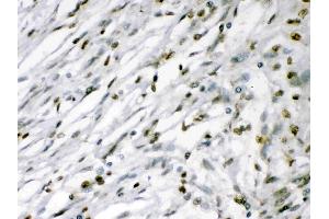 MEF2A was detected in paraffin-embedded sections of human meningeoma tissues using rabbit anti- MEF2A Antigen Affinity purified polyclonal antibody (Catalog # ) at 1 ? (MEF2A 抗体  (C-Term))