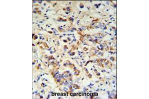 DCT Antibody IHC analysis in formalin fixed and paraffin embedded breast carcinoma followed by peroxidase conjugation of the secondary antibody and DAB staining. (DCT 抗体  (N-Term))
