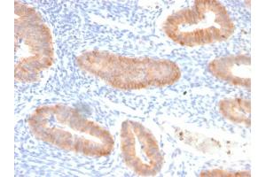 Formalin-fixed, paraffin-embedded human endo-cervical carcinoma stained with Interleukin 10 Recombinant Rabbit Monoclonal Antibody (IL10/2651R). (Recombinant IL-10 抗体)