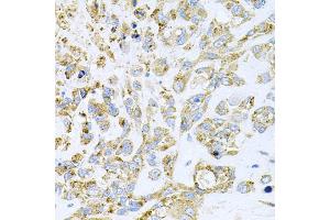 Immunohistochemistry of paraffin-embedded human lung cancer using HDAC3 antibody. (HDAC3 抗体)