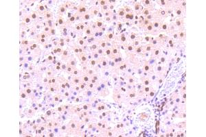 Immunohistochemistry (Paraffin-embedded Sections) (IHC (p)) image for anti-Signal Transducer and Activator of Transcription 3 (Acute-Phase Response Factor) (STAT3) (pSer727) antibody (ABIN5557530)