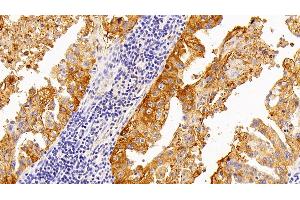 Detection of SPA2 in Human Lung cancer Tissue using Polyclonal Antibody to Surfactant Associated Protein A2 (SPA2) (SFTPA2 抗体  (AA 21-114))