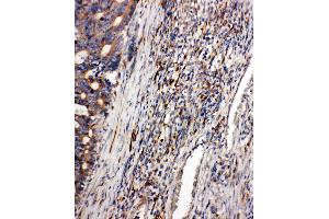 Anti-CD163 antibody,  IHC(P) IHC(P): Human Intestinal Cancer Tissue (CD163 抗体  (C-Term))