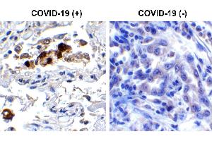 Immunohistochemistry Validation of SARS-CoV-2 (COVID-19) Spike RBD in COVID-19 Patient Lung Immunohistochemical analysis of paraffin-embedded COVID-19 patient lung tissue using anti- SARS-CoV-2 (COVID-19) Spike RBD antibody (ABIN6952968, 0. (SARS-CoV-2 Spike 抗体  (RBD))