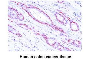 Paraffin embedded sections of human colon cancer tissue were incubated with anti-human MAT2A (1:50) for 2 hours at room temperature.