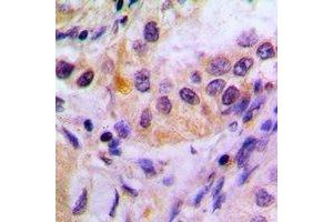 Immunohistochemical analysis of FKBP4 staining in human lung cancer formalin fixed paraffin embedded tissue section. (FKBP4 抗体)