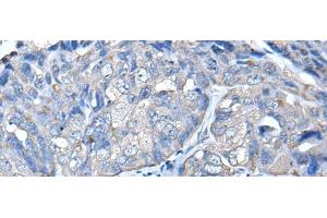 Immunohistochemistry of paraffin-embedded Human breast cancer tissue using PRKAR2A Polyclonal Antibody at dilution of 1:50(x200) (PRKAR2A 抗体)