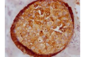 Immunohistochemistry (IHC) image for anti-Cadherin 1, Type 1, E-Cadherin (Epithelial) (CDH1) antibody (ABIN7127461)