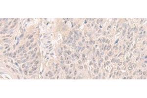 Immunohistochemistry of paraffin-embedded Human esophagus cancer tissue using HENMT1 Polyclonal Antibody at dilution of 1:30(x200) (HENMT1 抗体)