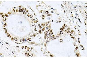 Immunohistochemistry of paraffin-embedded Human gastric cancer using MCL1 Polyclonal Antibody at dilution of 1:100 (40x lens). (MCL-1 抗体)
