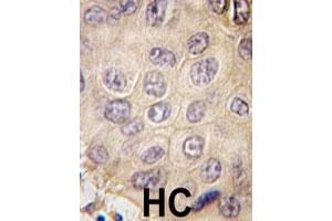 Formalin-fixed and paraffin-embedded human hepatocellular carcinoma reacted with EDA polyclonal antibody  , which was peroxidase-conjugated to the secondary antibody, followed by DAB staining. (Ectodysplasin A 抗体  (N-Term))