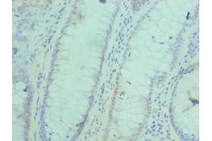 Immunohistochemistry of paraffin-embedded human colon cancer using ABIN7143052 at dilution of 1:100 (BAF53A 抗体  (AA 1-280))