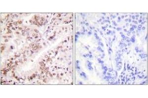 Immunohistochemistry analysis of paraffin-embedded human lung carcinoma, using Estrogen Receptor-alpha (Phospho-Tyr537) Antibody. (Estrogen Receptor alpha 抗体  (pTyr537))