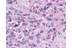 Anti-NPY4R / PPYR1 antibody IHC of human Brain, Glioblastoma. (NPY4R 抗体  (Extracellular Domain))