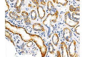 ABIN6258581 and ABIN6274584 at 1/100 staining Human kidney cancer and adjacent normal tissues by IHC-P. (beta 2 Adrenergic Receptor 抗体  (C-Term))