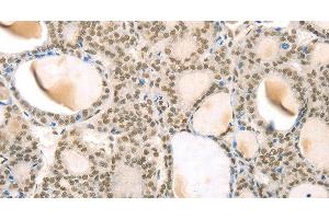 Immunohistochemistry of paraffin-embedded Human thyroid cancer using TSPAN13 Polyclonal Antibody at dilution of 1:35 (TSPAN13 抗体)