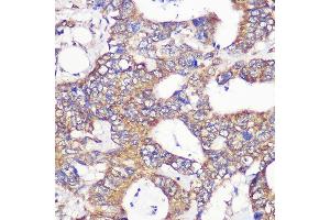 Immunohistochemistry of paraffin-embedded Human colon carcinoma using TUBGCP6 Rabbit pAb (ABIN7271055) at dilution of 1:100 (40x lens). (GCP6 抗体  (AA 600-900))