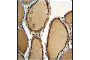 Immunohistochemistry analysis in formalin fixed and paraffin embedded human thyroid tissue reacted with CCDC128 Antibody (Center) followed by peroxidase conjugation of the secondary antibody and DAB staining. (KLRAQ1 抗体  (Middle Region))