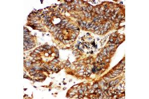 Anti-Calbindin Picoband antibody,  IHC(P): Human Intestinal Cancer Tissue (CALB1 抗体  (AA 2-175))