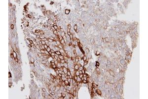 IHC-P Image Immunohistochemical analysis of paraffin-embedded D54MG xenograft, using KRT6A, antibody at 1:100 dilution. (KRT6A 抗体)