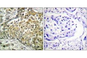 Immunohistochemistry analysis of paraffin-embedded human lung carcinoma tissue, using p53 (Acetyl-Lys379) Antibody. (p53 抗体  (acLys381))