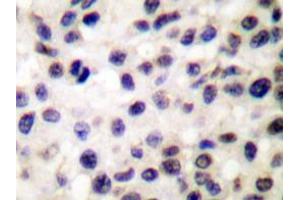 Immunohistochemistry analyzes of Stat5b antibody in paraffin-embedded human colon carcinoma tissue. (STAT5B 抗体)