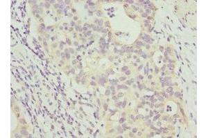 Immunohistochemistry of paraffin-embedded human bladder cancer using ABIN7144072 at dilution of 1:100 (ANAPC2 抗体  (AA 1-230))