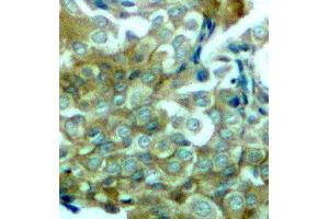 Immunohistochemistry (IHC) image for anti-Epidermal Growth Factor Receptor (EGFR) (pTyr1172) antibody (ABIN3019839) (EGFR 抗体  (pTyr1172))