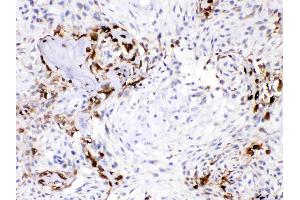 CA3 was detected in paraffin-embedded sections of human osteosarcoma tissues using rabbit anti- CA3 Antigen Affinity purified polyclonal antibody (Catalog # ) at 1 µg/mL. (CA3 抗体  (AA 14-235))