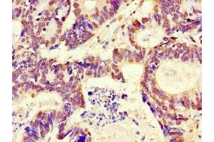 Immunohistochemistry of paraffin-embedded human colon cancer using ABIN7167735 at dilution of 1:100 (RFPL4B 抗体  (AA 1-263))