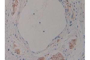 Detection of NT-ProANP in Human Stomach cancer Tissue using Polyclonal Antibody to N-Terminal Pro-Atrial Natriuretic Peptide (NT-ProANP) (PRO-ANP 抗体  (AA 25-123))