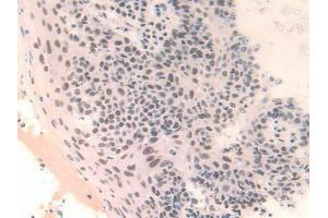 IHC-P analysis of Human Skin Cancer Tissue, with DAB staining. (FAM19A3 抗体  (AA 44-130))