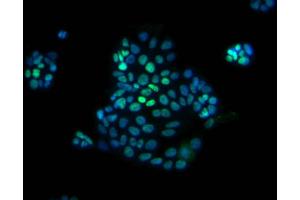Immunofluorescent staining of human colorectal adenocarcinoma (CDX2 抗体)