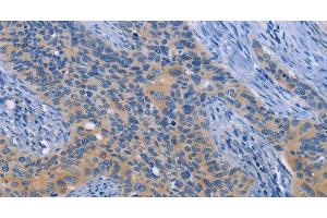 Immunohistochemistry of paraffin-embedded Human cervical cancer tissue using NEK8 Polyclonal Antibody at dilution 1:30 (NEK8 抗体)