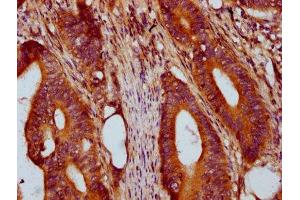 IHC image of ABIN7172139 diluted at 1:400 and staining in paraffin-embedded human colon cancer performed on a Leica BondTM system. (PRSS16 抗体  (AA 352-489))