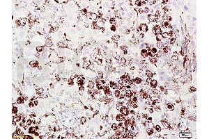 Formalin-fixed and paraffin embedded mouse melanoma labeled with Anti-Melanoma HMB45/Melanoma/Melan-A/MART-1 Polyclonal Antibody, Unconjugated (ABIN724190) at 1:200 followed by conjugation to the secondary antibody and DAB staining. (MLANA 抗体  (AA 51-118))