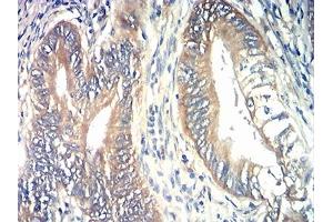 Immunohistochemical analysis of paraffin-embedded rectum cancer tissues using TIA1 mouse mAb with DAB staining. (TIA1 抗体  (AA 1-215))